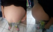 Justiça nega pela 4ª vez interrupção de gravidez de siamesas sem chances de sobrevivência